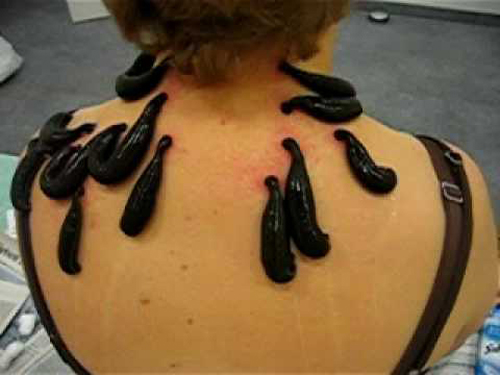 Image result for leeches on the back